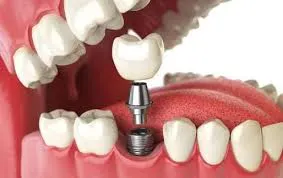 Implanturile dentare. Indicatiile medicilor inainte si dupa inserare