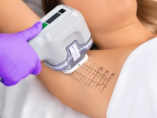 Tratamentul hiperhidrozei cu botox