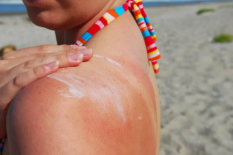 Tratamentul corect al arsurilor solare