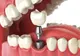 Implanturile dentare. Indicatiile medicilor inainte si dupa inserare